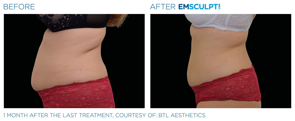 Emsculpt_neo_PIC_Ba-card-female-abdomen-025