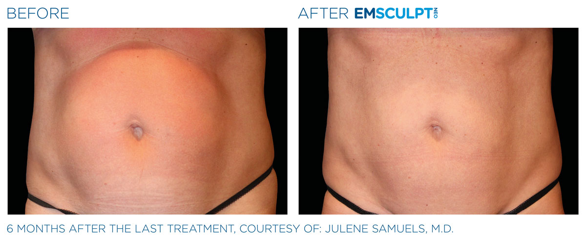 Emsculpt_neo_PIC_Ba-card-female-abdomen-039