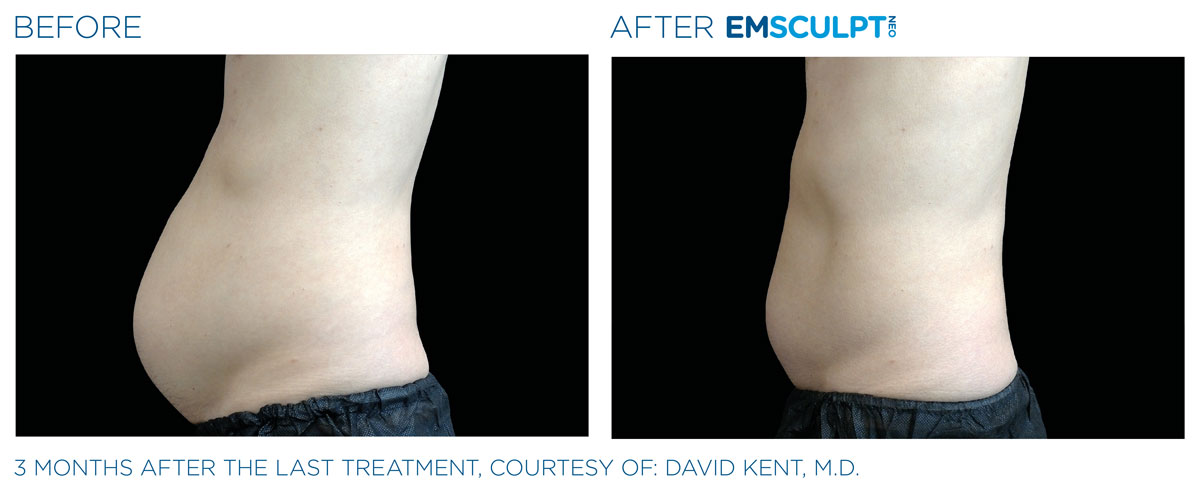 Emsculpt_neo_PIC_Ba-card-male-abdomen-022