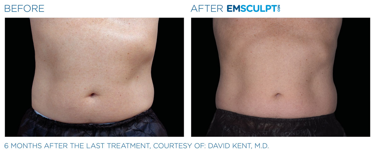 Emsculpt_neo_PIC_Ba-card-male-abdomen-043