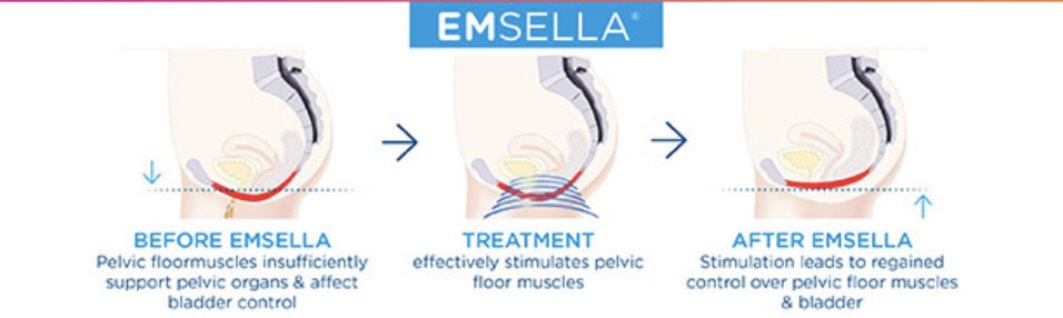 Before and after Esmella