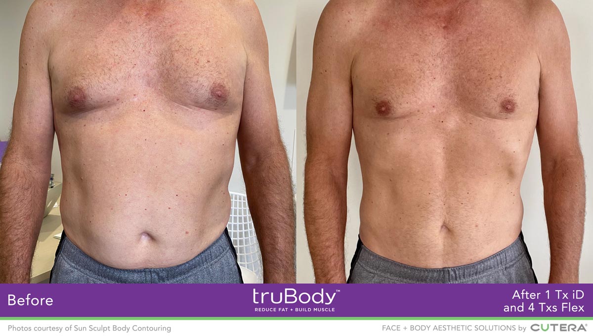 Say goodbye to stubborn fat and hello to a more toned and contoured body  with truBody. Our Body Contouring treatment is personalised to